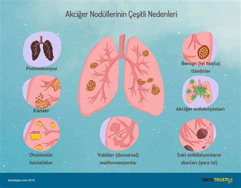 Akciğer nodülünün tedavisi